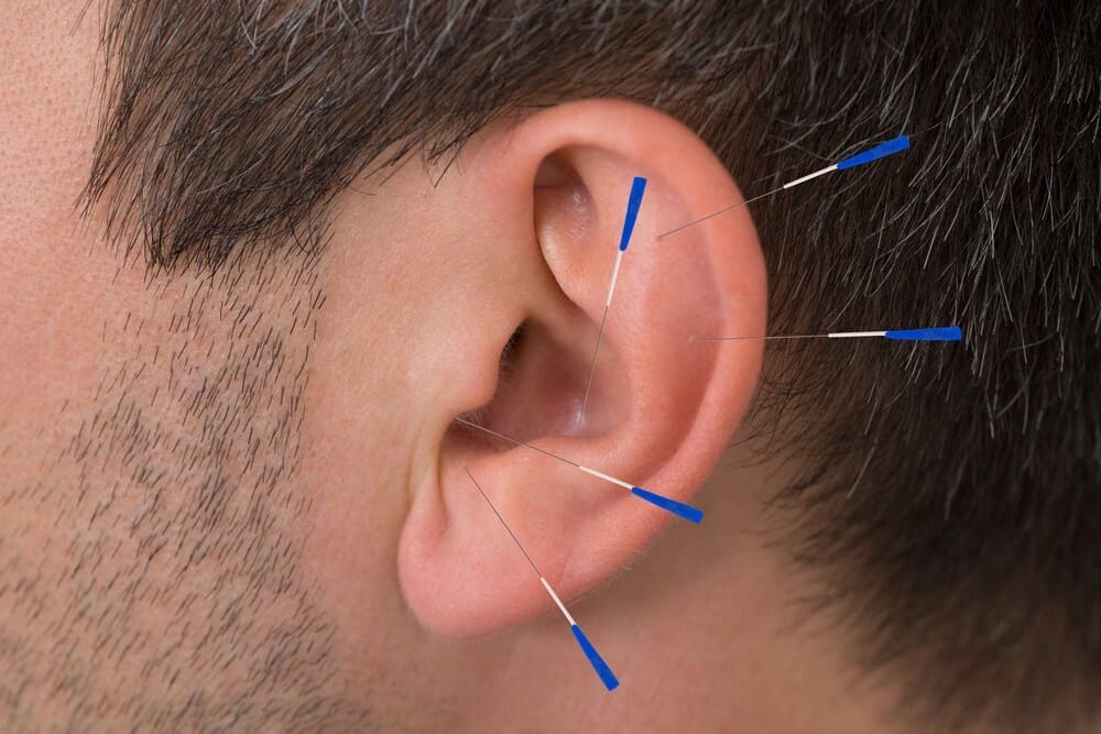 acupuncture clinic near me